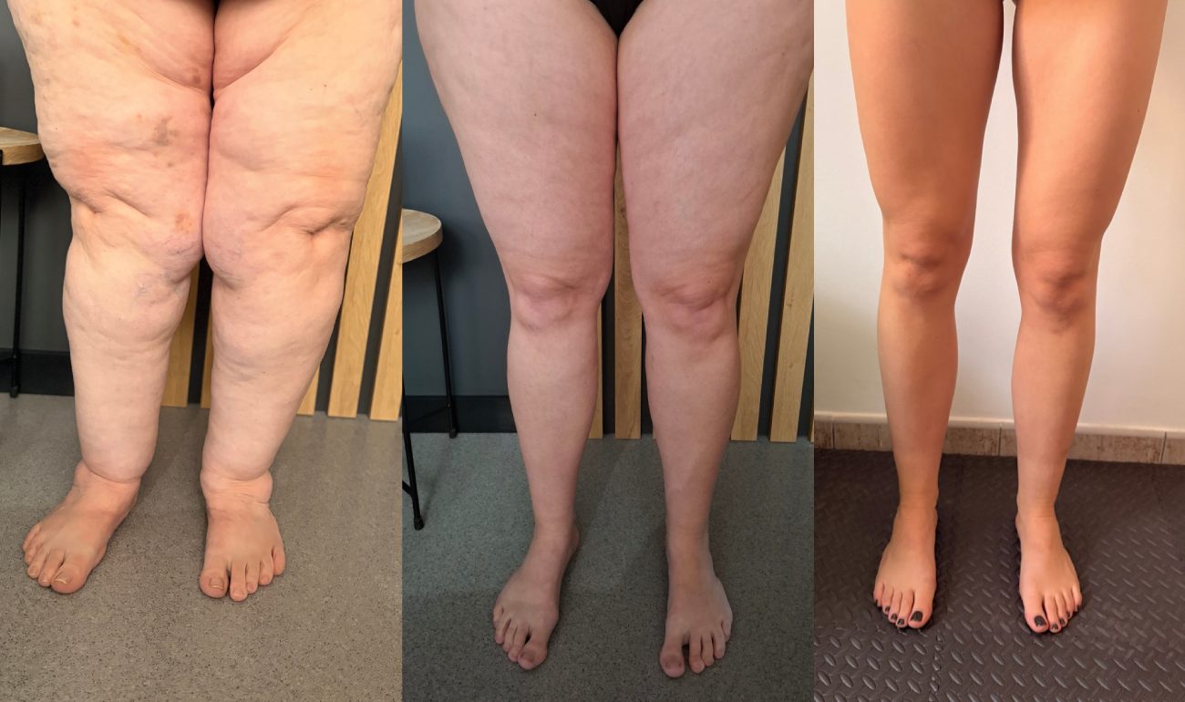 lipoedema rzeszów terapia obrzęków - różne stadia