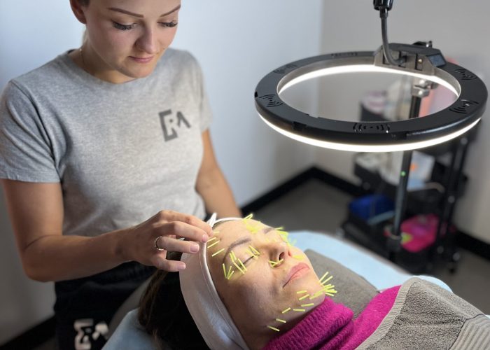 igłoterapia estetyczna